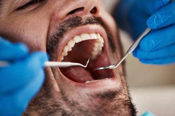 Best Emergency Dental Extractions in Esparto, CA